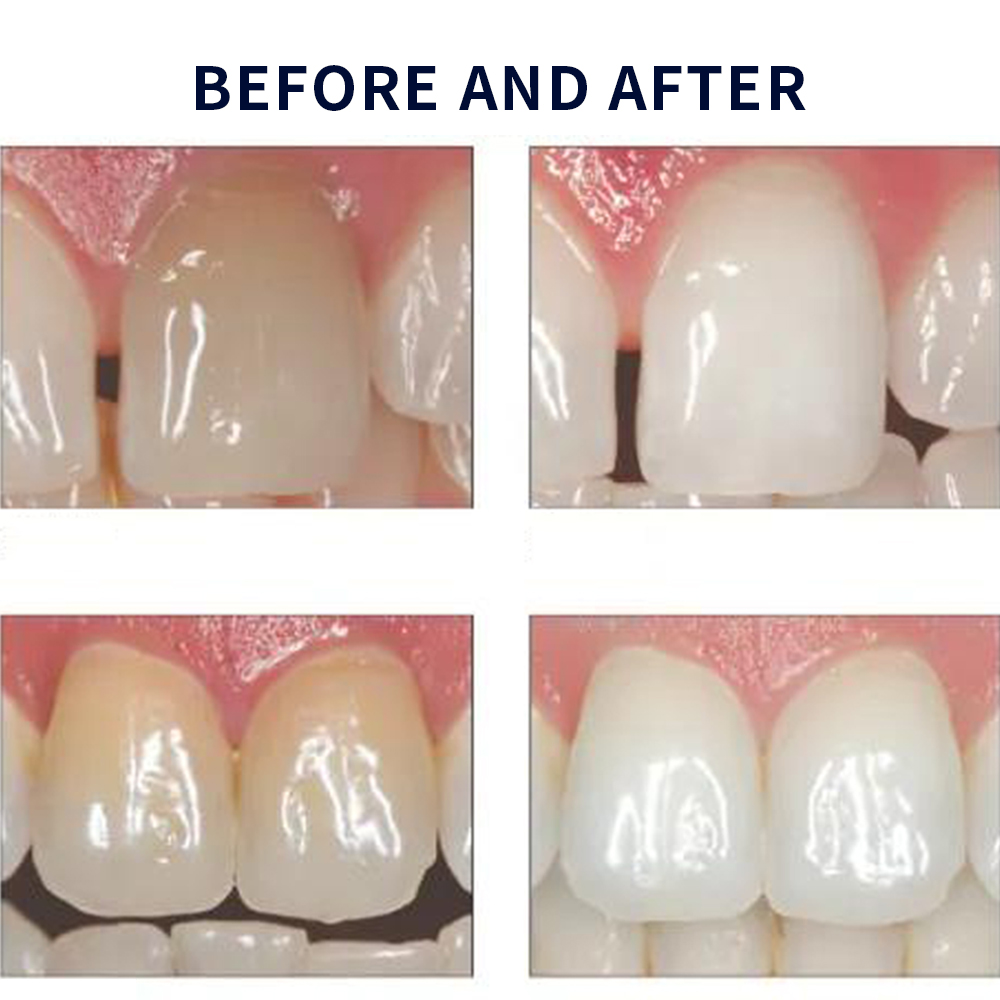 Opalwisdom-Kit de Blanchiment  - Teeth Whitening Home Kit avis et prix