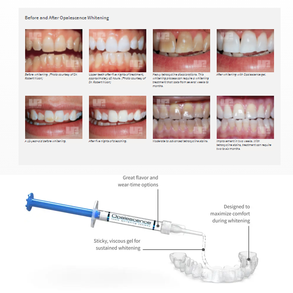 Opalwisdom-Kit de Blanchiment  - Teeth Whitening Home Kit avis et prix
