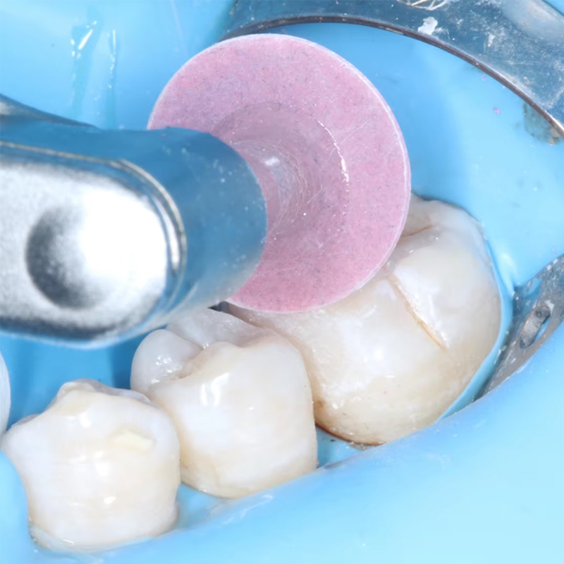40 disques de polissage dentai - Whitening Teeth Dentist avis et prix