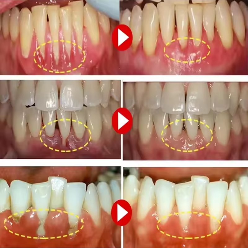 Gel blanchissant pour les dent - Teeth Whitening Gels avis et prix