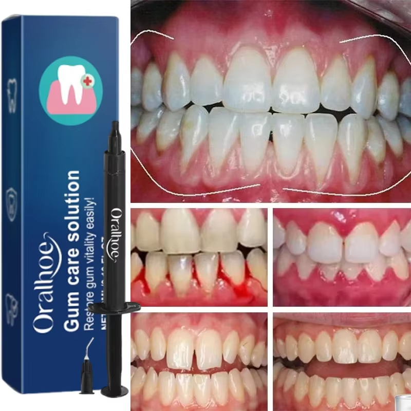 Gel blanchissant pour les dent - Teeth Whitening Gels avis et prix