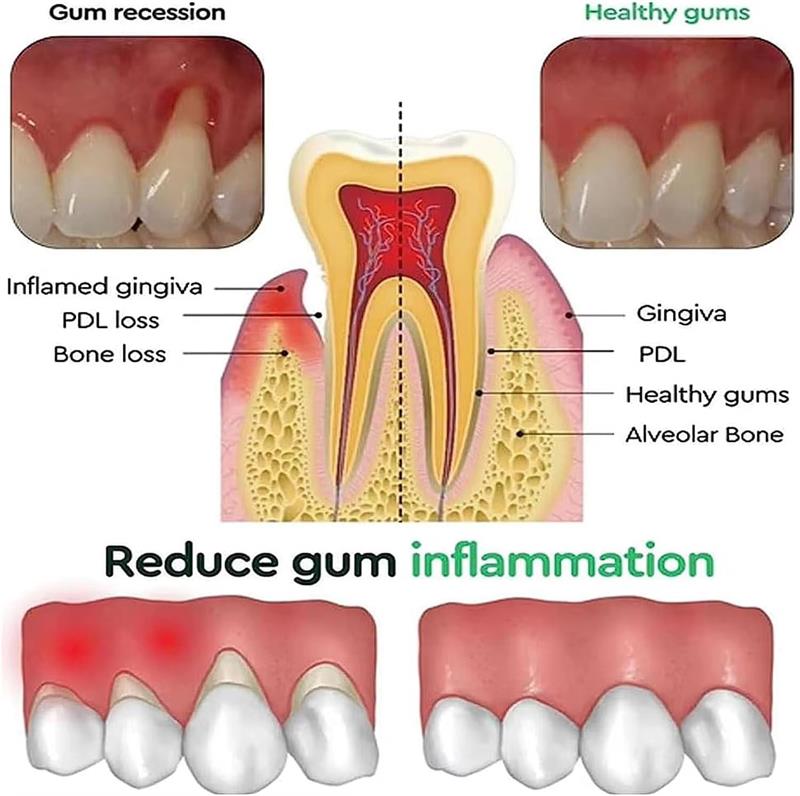 Gel blanchissant pour les dent - Teeth Whitening Gels avis et prix