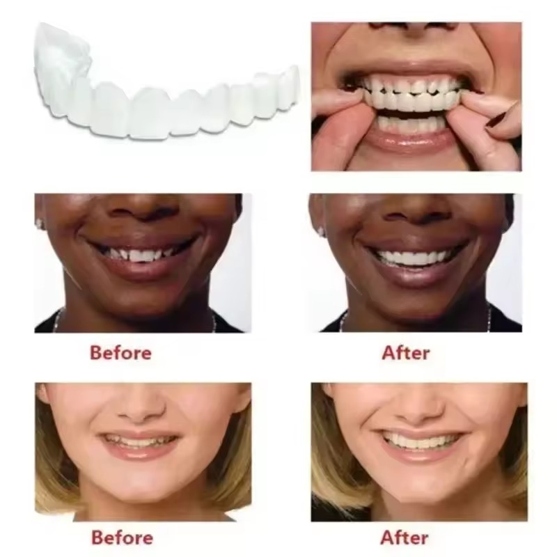 Veneers dentaires blanchissant - Teeth Whitening Veneers avis et prix