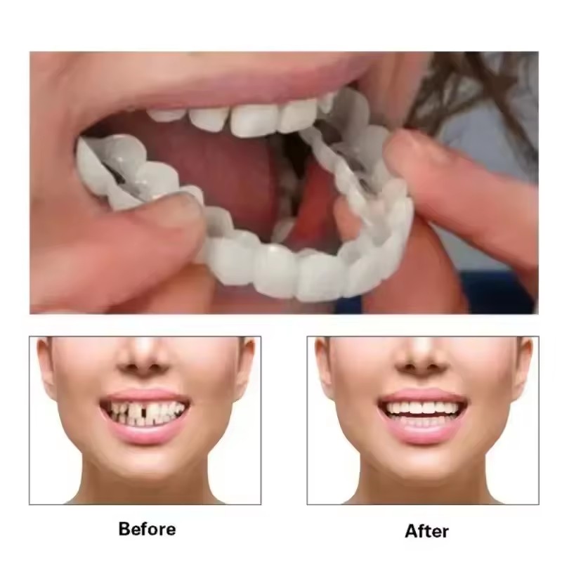 Veneers dentaires blanchissant - Teeth Whitening Veneers avis et prix