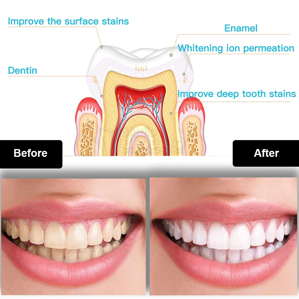 Kit de blanchiment des dents d - Teeth Whitening With Hydrogen Peroxide avis et prix